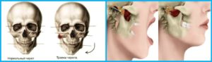 не могу полностью открыть рот и боль в челюсти