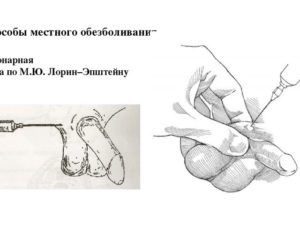 Новокаиновая блокада семенного канатика