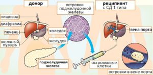 Трансплантация островковых клеток в качестве одного из способов лечения сахарного диабета