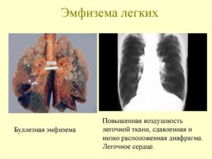 инвалидность и исход при буллезной эмфиземе легких