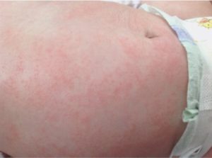 Аллергия у 8-месячного ребенка