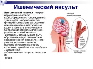 Ишемический инсульт головного мозга