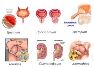 Зуд в мочеиспускательном канале