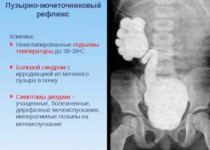 Пузырно мочеточниковый рефлюкс 2 степени у 8 мес ребенка