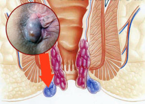 Симптомы болезни - боли в заднем проходе