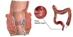 Можно ли геморрой спутать с раком?