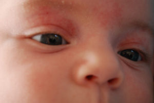 Расширенная вена над глазом у ребенка