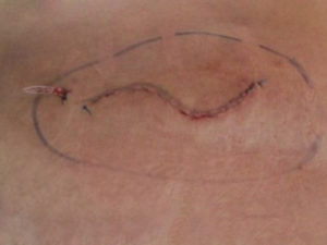 копчиковый ход, почернела рана после операции