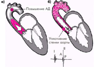 Уплотнение дуги аорты