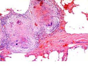 Bacillinum (Продукт мацерации туберкулезного легкого)