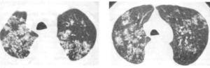 Bacillinum (Продукт мацерации туберкулезного легкого)