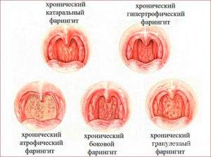 Хронический фарингит