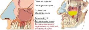 Хроническое воспаление верхнечелюстной пазухи