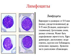 Анализ крови (широкоцитоплазменные лимфоциты))