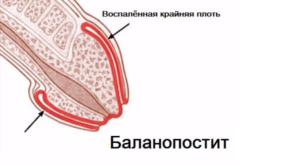 Боль при касании оголенной головки полового члена