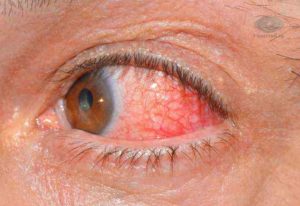 Воспалительные заболевания глазницы