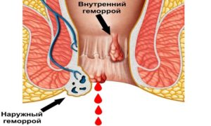 Простудил анус?