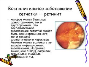 Воспалительные заболевания сетчатки (ретиниты)