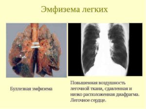 Буллезная болезнь легких