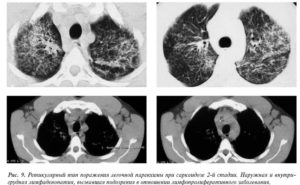 саркоидоз, результаты КТ