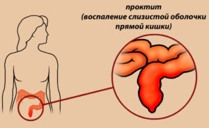 Проктит при беременности