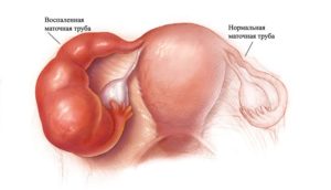 гидросальпинкс и беременность