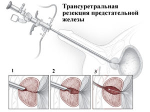 Можно ли делать массаж предстательной железы при кальцинатах