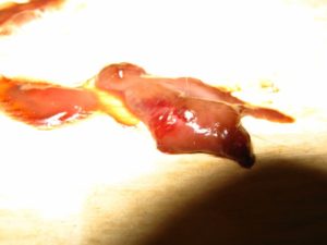 Астенозооспермия-причина замершей беременности