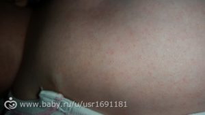 сыпь на теле у 7 месячного ребенка
