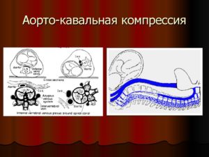 Осложнения беременности в III триместре: Аортокавальная компрессия