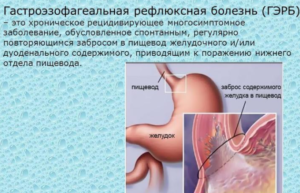 Гастроэзофагеальная рефлюксная болезнь (ГЭРБ)