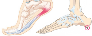 Пяточная шпора, плантарныи фасциит