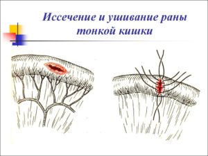 Травмы тонкой кишки