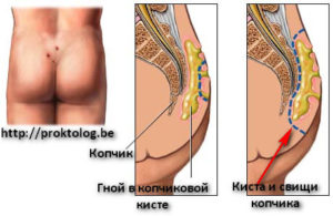 Нарост на копчике