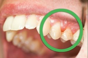 Симптомы болезни - боли в зубах при беременности
