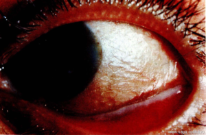 Роговично-конъюнктивальный ксероз (синдром «сухого» глаза)