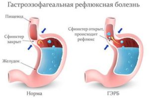 Изжога и гастроэзофагеальная рефлюксная болезнь (ГЭРБ)