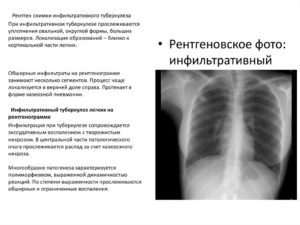 Метатуберкулезные изменения