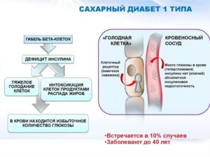 Сахарный диабет 1 типа: Лечение дома