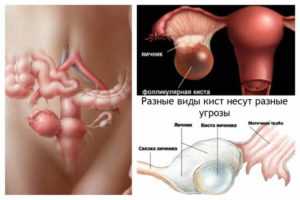 Симптомы болезни - боли в яичниках при беременности