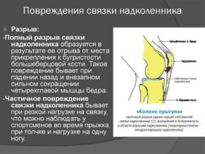 Частичный разрыв медиального удерживателя надколенника 2 степени, синовит