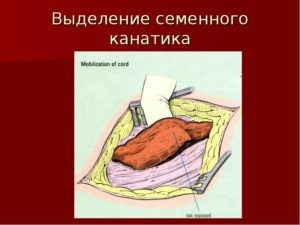 Новокаиновая блокада семенного канатика