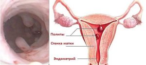 Обнаружен микрополипоз эндометрия, планирую ЭКО