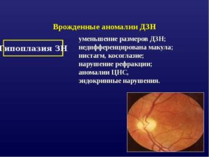 Аномалии развития диска зрительного нерва