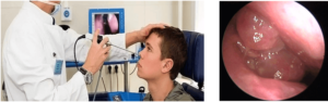 Показания и методика диагностической эндоскопии полости носа и околоносовых пазух