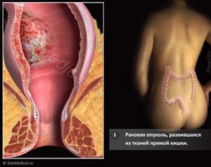 Симптомы болезни - боли в заднем проходе