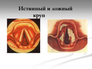 Подскладочный ларингит (ложный круп)