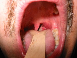 Кость или рана в горле
