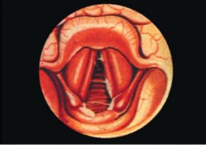 Подскладочный ларингит (ложный круп)
