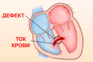 Вроджений дефект міжпередсердної перегородки.